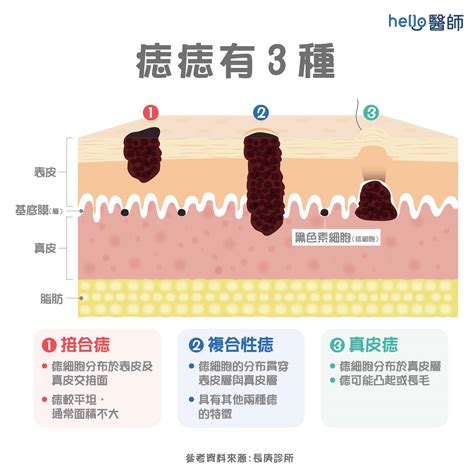 如何避免長痣|痣形成的原因？痣長毛、痣變多變大是痣病變？5招判。